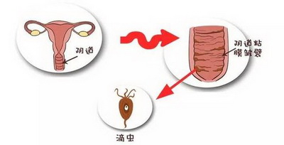 杭州治疗阴道炎哪个医院好